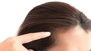 hairloss-treatment